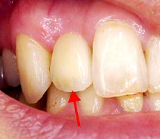 前歯のインプラント治療例４