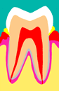 歯周病イメージ１