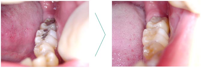 審美歯科 治療例