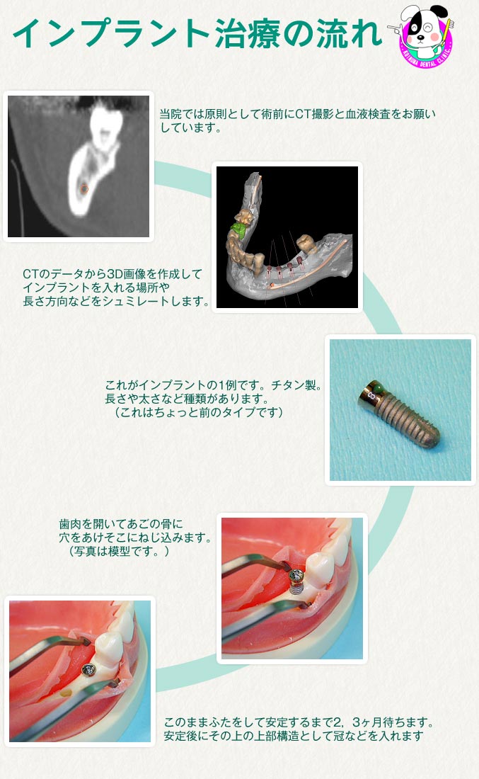 インプラント治療の流れ