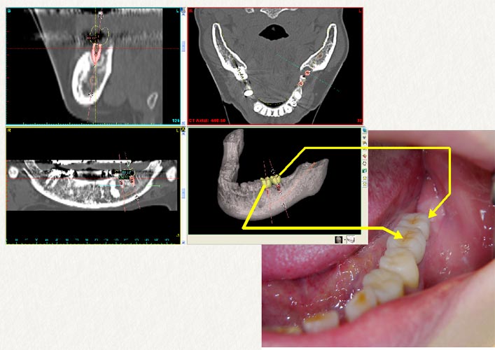 臼歯のインプラント治療例