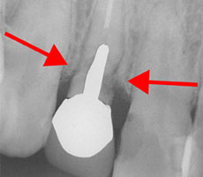 前歯のインプラント治療例１