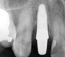 前歯のインプラント治療例３