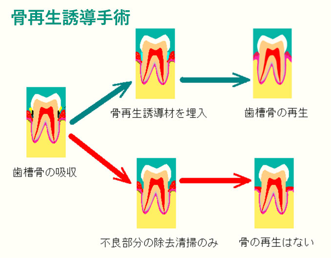 再生誘導手術のイメージ