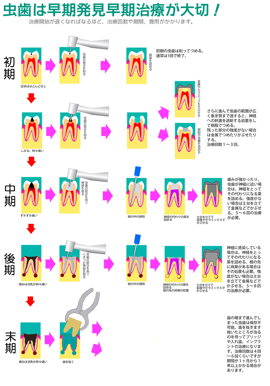 虫歯治療イメージ図