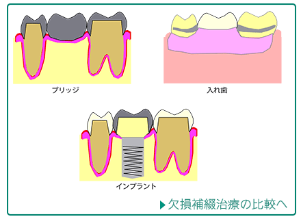 欠損補綴治療の比較